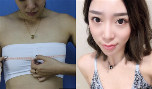 上海伊莱美李旭东隆胸怎么样?案例,价格,口碑