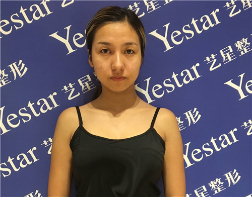 北京艺星翟红宇隆胸怎么样?案例,价格,口碑