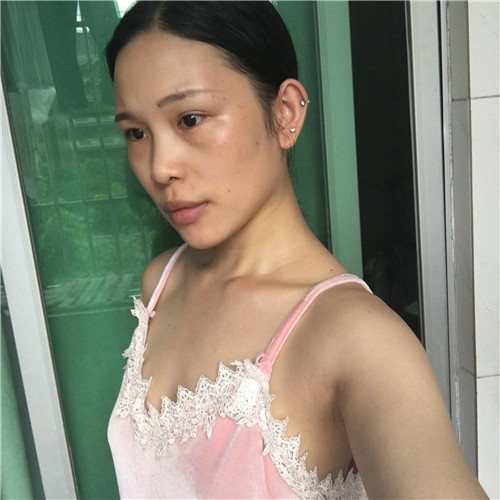 北京艺美王东丰胸怎么样?案例,价格,口碑