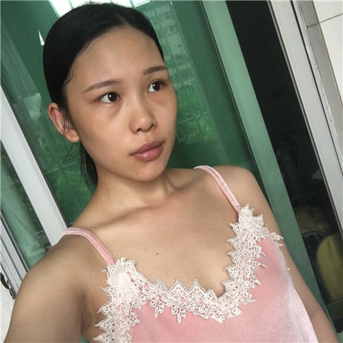 北京艺美王东丰胸怎么样?案例,价格,口碑