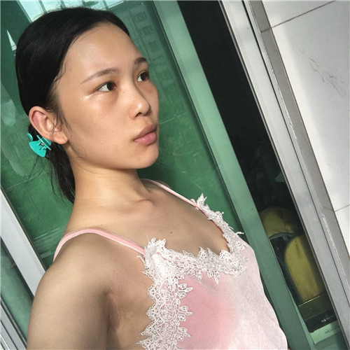 北京艺美王东丰胸怎么样?案例,价格,口碑
