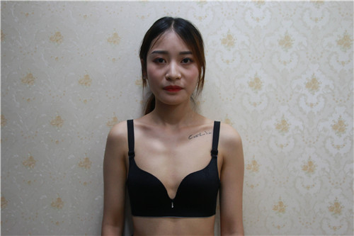 上海华美李健隆胸怎么样?案例,价格,口碑