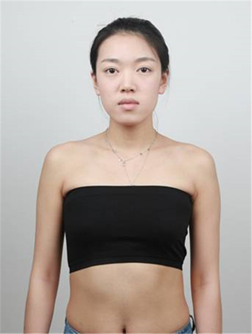 上海美希李攀丰胸怎么样?案例,价格,口碑