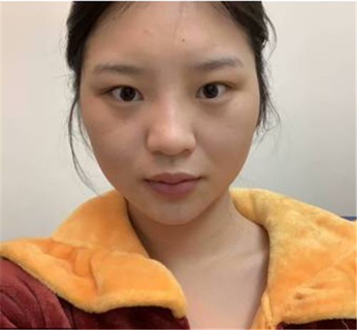 北京柏丽冯振科做鼻子怎么样?案例_价格_口碑
