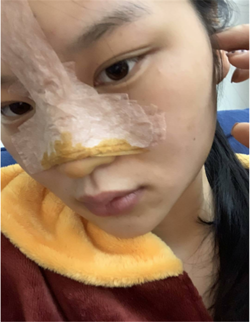 北京柏丽冯振科做鼻子怎么样?案例_价格_口碑