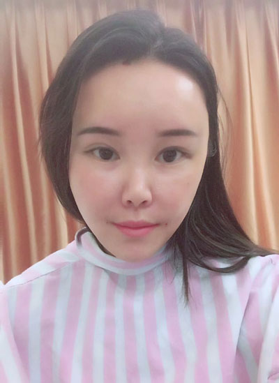 北京伟力嘉美信叶文珏自体脂肪移植怎么样?案例_价格_口碑
