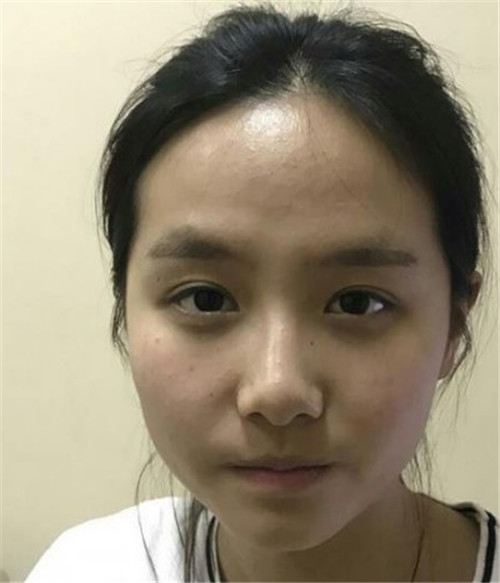 北京画美马群做鼻子怎么样?案例?价格?口碑