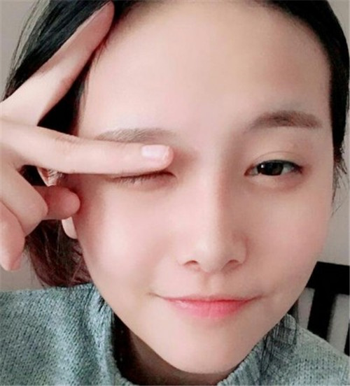 北京画美马群做鼻子怎么样?案例?价格?口碑