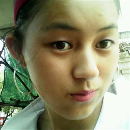 上海联合丽格成浩割双眼皮怎么样?案例_价格_口碑