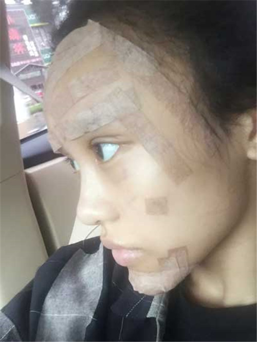 北京玉之光王明利自体脂肪填充怎么样?案例_价格_口碑