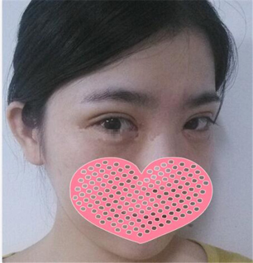 北京美莱谭章梅割双眼皮怎么样?案例_价格_口碑