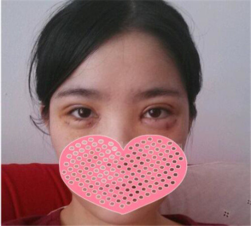 北京美莱谭章梅割双眼皮怎么样?案例_价格_口碑