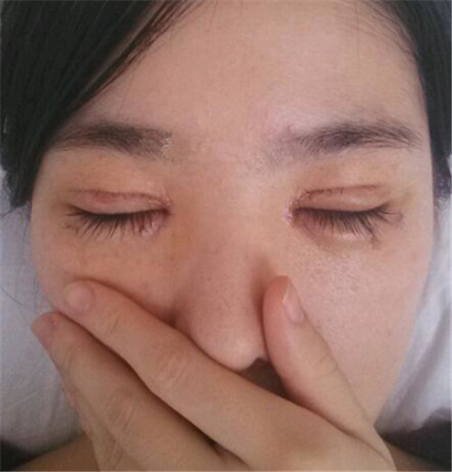北京美莱谭章梅割双眼皮怎么样?案例_价格_口碑