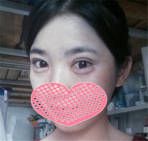 北京美莱谭章梅割双眼皮怎么样?案例_价格_口碑