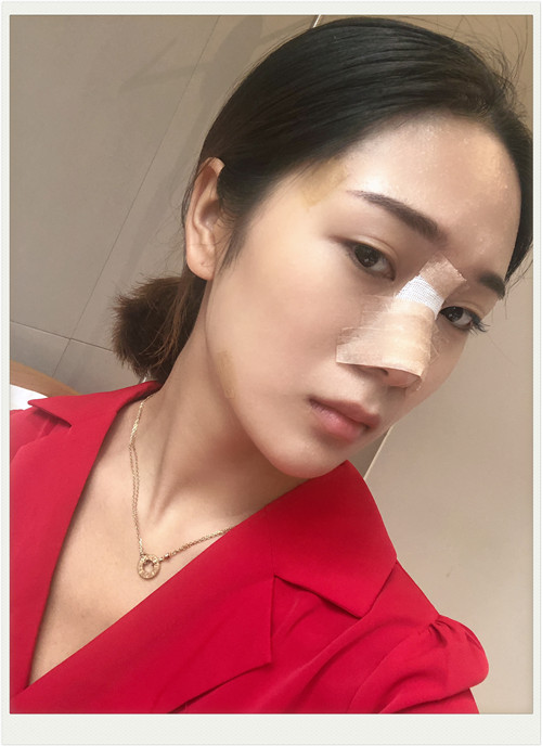 北京艺星隆鼻怎么样?案例_价格_口碑