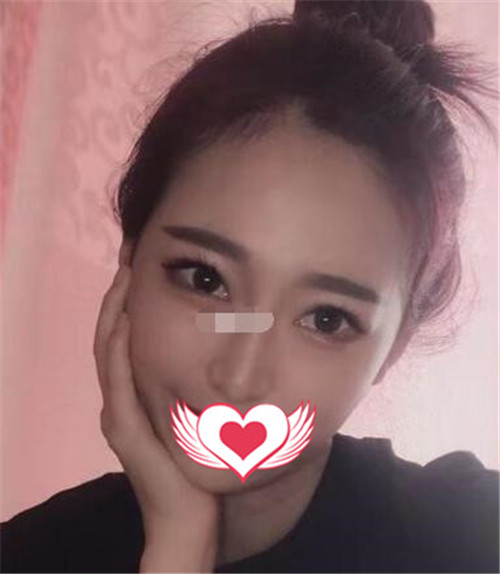 上海安缦刘思达自体脂肪填充怎么样?案例_价格_口碑