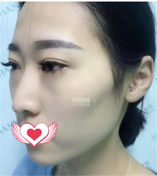上海安缦刘思达自体脂肪填充怎么样?案例_价格_口碑