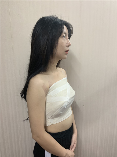 北京华韩余恩旭隆胸怎么样?案例_价格_口碑