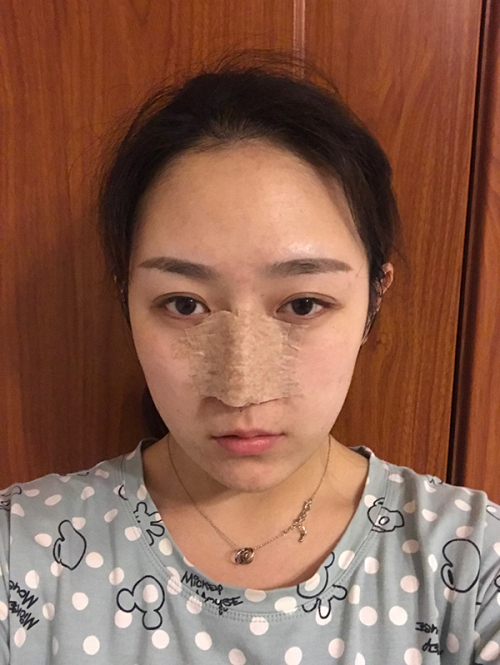 北京画美徐学东做鼻子怎么样?案例_价格_口碑