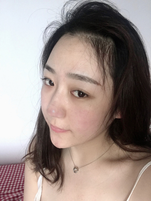 北京画美徐学东做鼻子怎么样?案例_价格_口碑