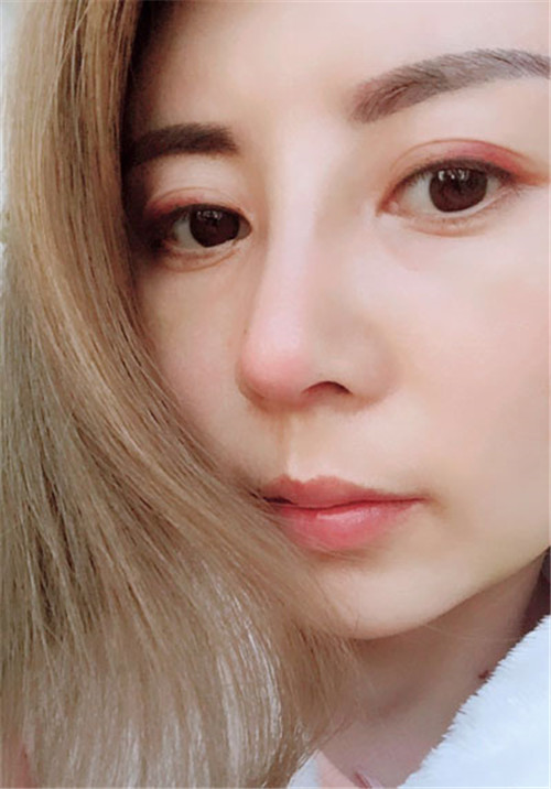 上海华美叶丽萍做鼻子怎么样?案例_价格_口碑
