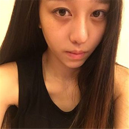 上海华美谢卫国自体脂肪填充怎么样?案例_价格_口碑