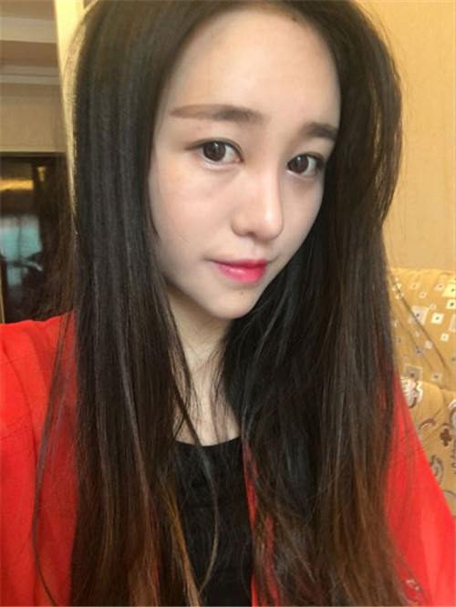上海华美谢卫国自体脂肪填充怎么样?案例_价格_口碑