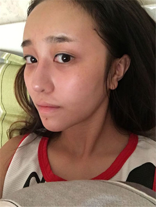 上海华美谢卫国自体脂肪填充怎么样?案例_价格_口碑