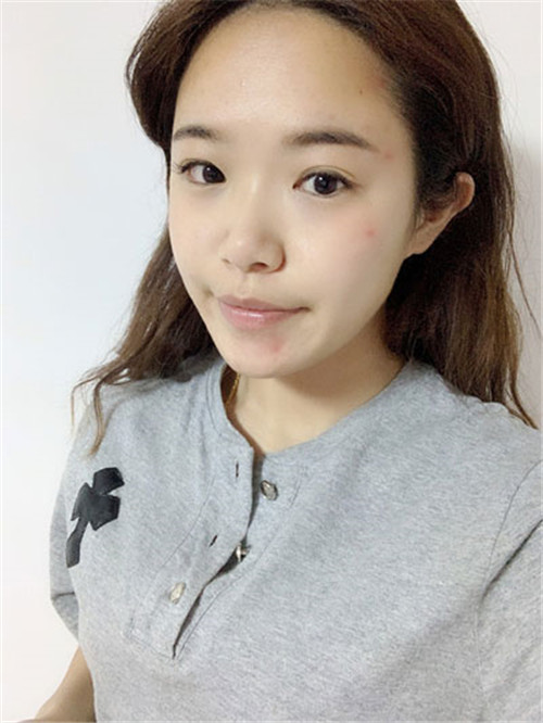 陈斌做鼻子怎么样?案例_价格_口碑