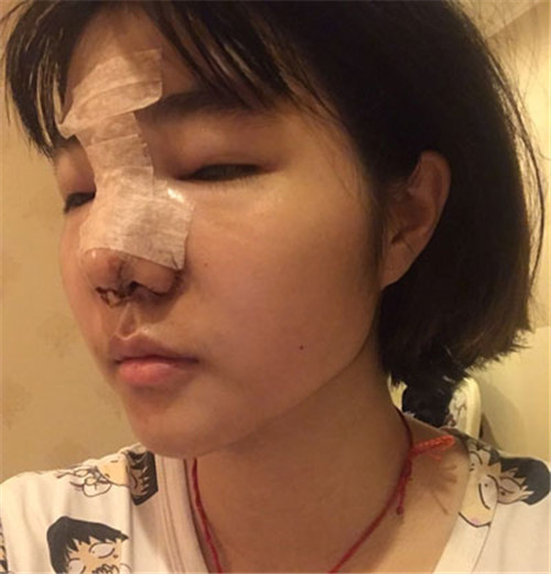 北京京民靳玉彪做鼻子怎么样?案例_价格_口碑