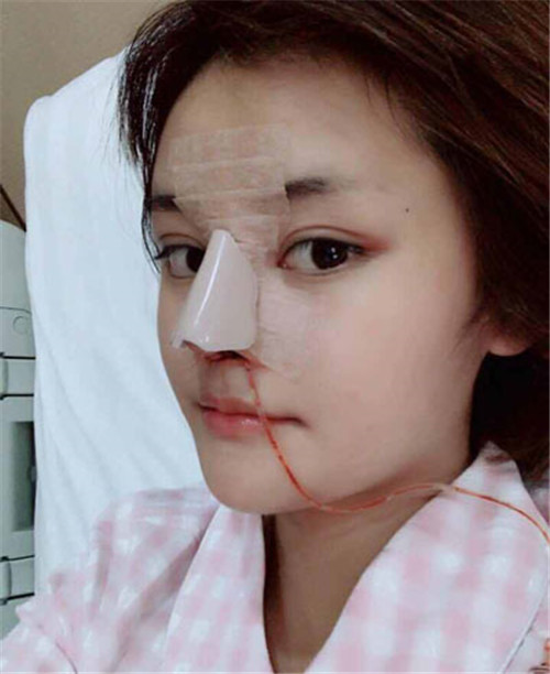 上海华美李健隆鼻怎么样?案例,价格_口碑