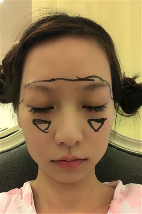 上海华美李健自体脂肪填充怎么样?案例_价格_口碑