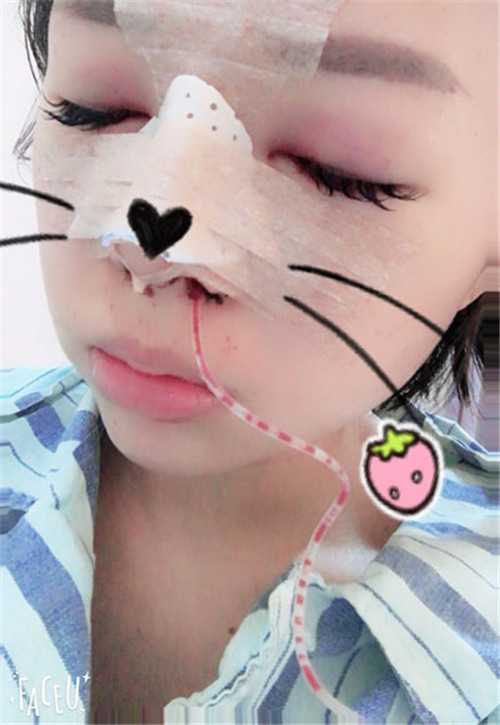 上海华美张朋做鼻子怎么样?案例_价格_口碑