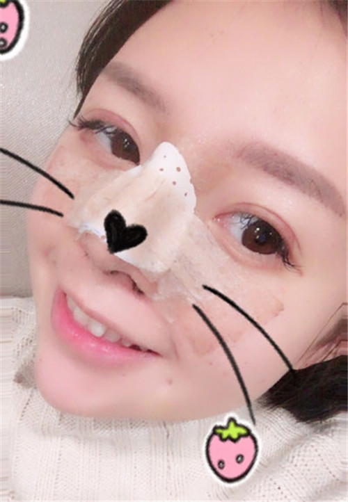 上海华美张朋做鼻子怎么样?案例_价格_口碑
