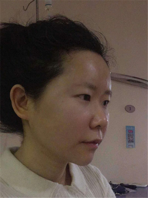 北京韩啸姜辉自体脂肪移植怎么样?案例_价格_口碑