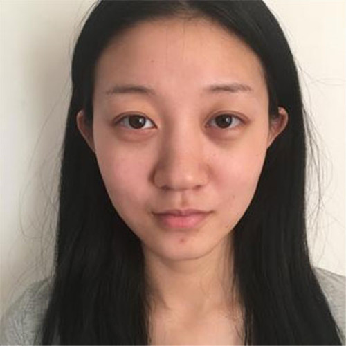北京清木马梅生自体脂肪移植怎么样?案例_价格_口碑