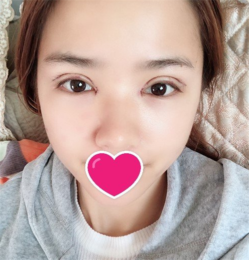 北京京民王志坚割双眼皮怎么样?案例_价格
