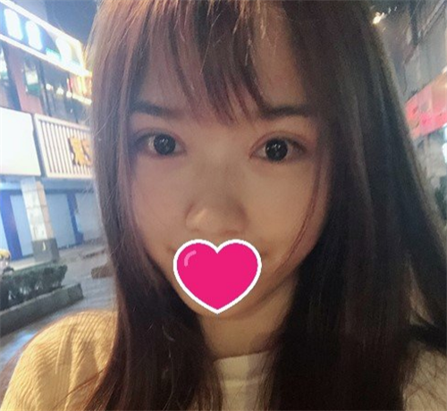 北京京民王志坚割双眼皮怎么样?案例_价格