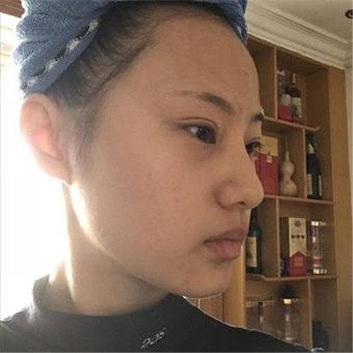 上海德琳朱麟自体脂肪填充怎么样?案例_价格