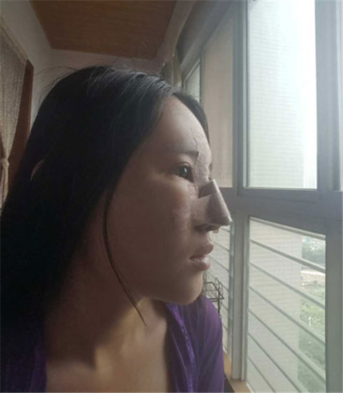 上海九院戴传昌做鼻子怎么样?案例_价格