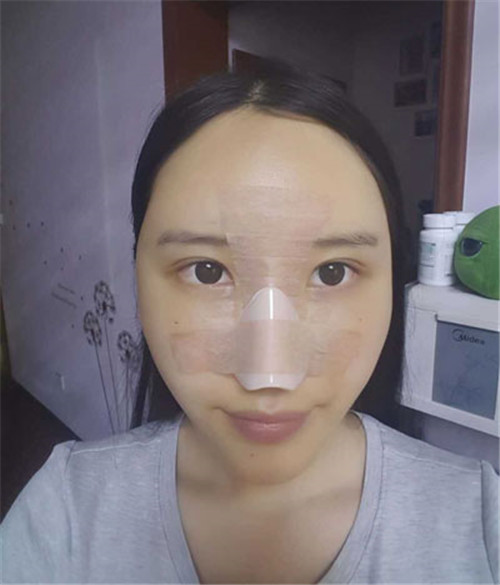 上海九院戴传昌做鼻子怎么样?案例_价格
