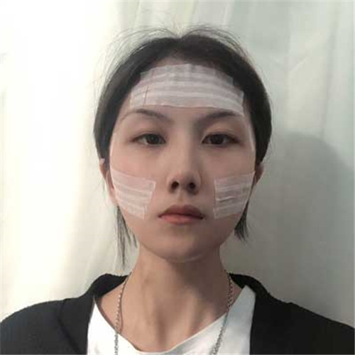 上海薇琳张怀军自体脂肪移植怎么样?案例_价格