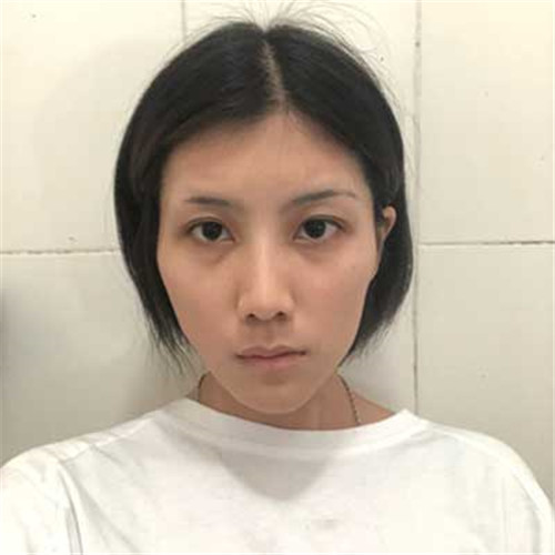 上海薇琳张怀军自体脂肪移植怎么样?案例_价格