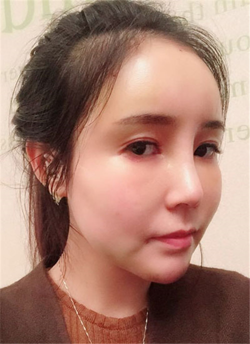 北京柏丽于海军做鼻子怎么样?案例_价格