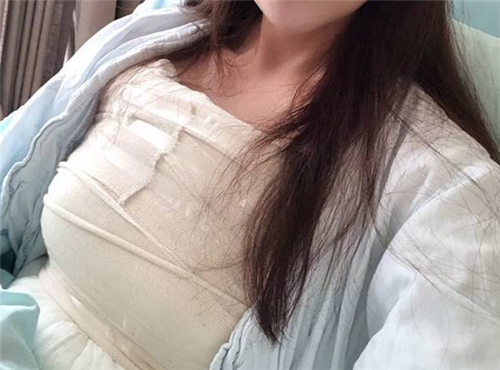 袁玉坤自体脂肪移植怎么样?案例_价格