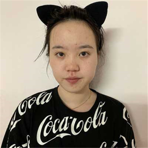 上海薇琳曹芳自体脂肪移植怎么样?案例_价格