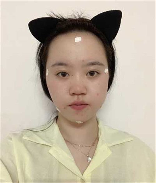 上海薇琳曹芳自体脂肪移植怎么样?案例_价格