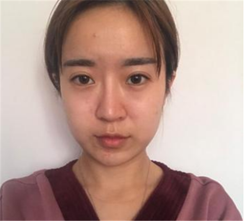 上海华美何斌自体脂肪移植怎么样?案例_价格