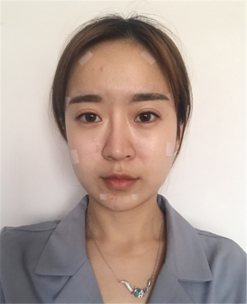 上海华美何斌自体脂肪移植怎么样?案例_价格