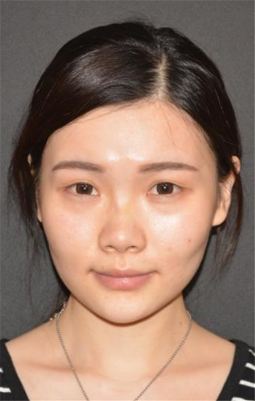 北京柏丽李劲良隆鼻怎么样?案例_价格